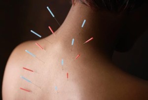 corbis_rf_photo_of_acupuncture_needles_in_womans_back